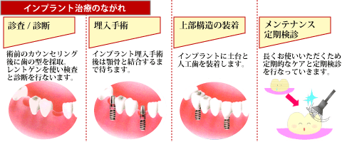 インプラント治療の流れ